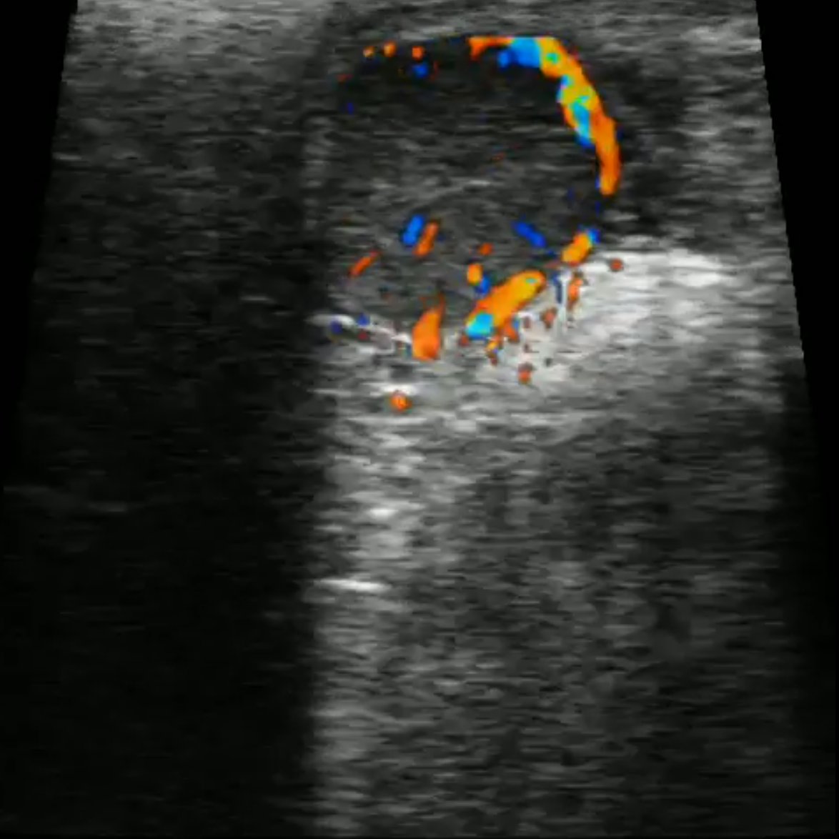 Discover early negative pregnancy with the CFM Doppler